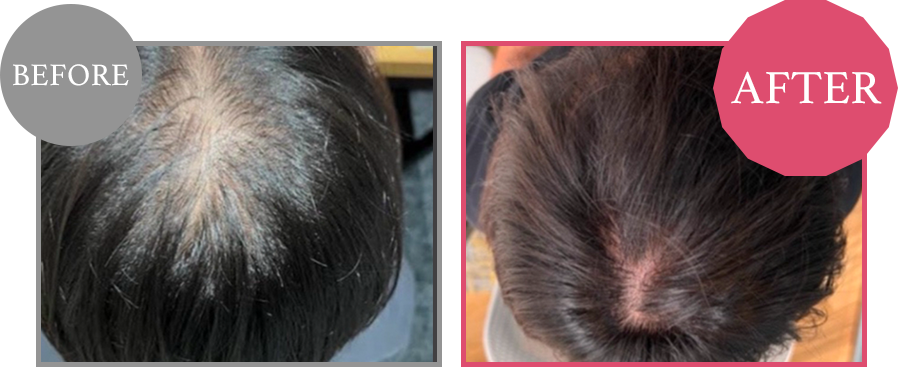 毛髪再生 Before/After 1