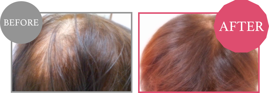 毛髪再生 Before/After 2