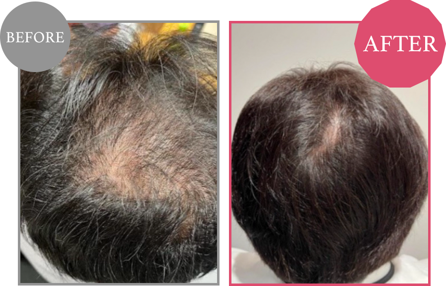 毛髪再生 Before/After 3