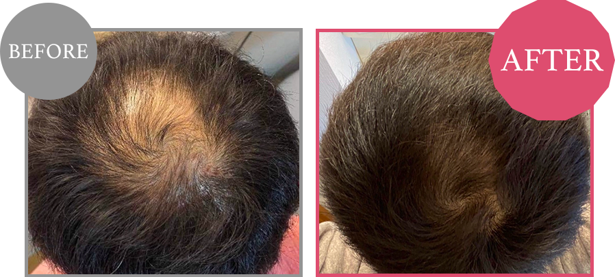 毛髪再生 Before/After 4
